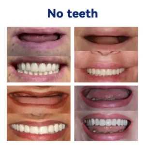DIYSTAR™ Silicone Denture Ruler Set