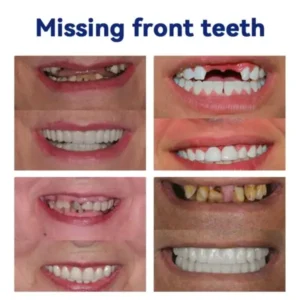DIYSTAR™ Silicone Denture Ruler Set