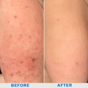 Ourlyard® Skin Treatment Cream
